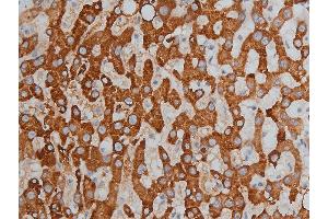 ABIN6256332 and ABIN6267233 at 1/200 staining human liver cancer tissue sections by IHC-P. (HDAC3 Antikörper  (pSer424))