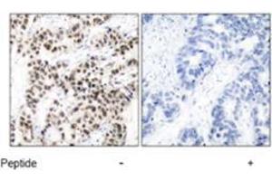 Immunohistochemical analysis of paraffin-embedded human breast carcinoma tissue using MYC polyclonal antibody  . (c-MYC Antikörper)