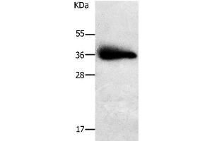 Western Blot analysis of Human liver cancer tissue using PLPP1 Polyclonal Antibody at dilution of 1:650 (PLPP1 Antikörper)