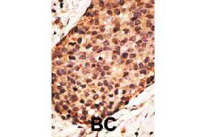 Formalin-fixed and paraffin-embedded human cancer tissue reacted with MMP16 polyclonal antibody  , which was peroxidase-conjugated to the secondary antibody, followed by AEC staining. (MMP16 Antikörper  (N-Term))