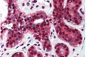 Human Breast (formalin-fixed, paraffin-embedded) stained with TP73 antibody ABIN290398 at 5 ug/ml followed by biotinylated goat anti-rabbit IgG secondary antibody ABIN481713, alkaline phosphatase-streptavidin and chromogen. (Tumor Protein p73 Antikörper  (AA 75-125))
