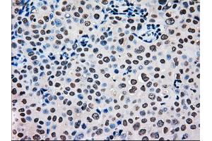 Immunohistochemical staining of paraffin-embedded Carcinoma of pancreas tissue using anti-MRI1mouse monoclonal antibody. (MRI1 Antikörper)