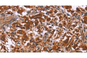 Immunohistochemistry of paraffin-embedded Human thyroid cancer using ING2 Polyclonal Antibody at dilution of 1:40 (ING2 Antikörper)