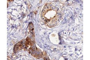 ABIN6266873 at 1/100 staining human Prostate cancer tissue sections by IHC-P. (STEAP4 Antikörper  (C-Term))