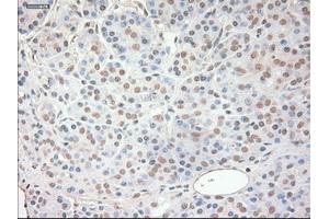 Immunohistochemical staining of paraffin-embedded Adenocarcinoma of ovary tissue using anti-SOX17 mouse monoclonal antibody. (SOX17 Antikörper  (AA 177-414))