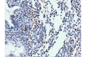 Immunohistochemical staining of paraffin-embedded Adenocarcinoma of Human endometrium tissue using anti-ARHGAP25 mouse monoclonal antibody. (ARHGAP25 Antikörper)
