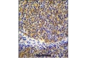 PSMB11 Antibody (C-term) (ABIN655286 and ABIN2844876) immunohistochemistry analysis in formalin fixed and paraffin embedded human thymoma followed by peroxidase conjugation of the secondary antibody and DAB staining. (PSMB11 Antikörper  (C-Term))