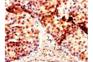 Immunohistochemistry of paraffin-embedded human breast cancer using ABIN7150637 at dilution of 1:100 (DMRT1 Antikörper  (AA 195-363))