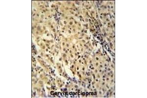 FOXC2 Antibody (Center ) (ABIN651936 and ABIN2840463) immunohistochemistry analysis in formalin fixed and paraffin embedded human cervix carcinoma followed by peroxidase conjugation of the secondary antibody and DAB staining.