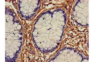 Immunohistochemistry of paraffin-embedded human colon cancer using ABIN7167768 at dilution of 1:100