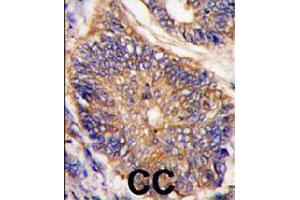 Formalin-fixed and paraffin-embedded human colon carcinoma tissue reacted with LDLRAP1 polyclonal antibody  , which was peroxidase-conjugated to the secondary antibody, followed by DAB staining. (LDLRAP1 Antikörper  (N-Term))