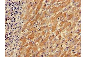Immunohistochemistry of paraffin-embedded human liver cancer using ABIN7173558 at dilution of 1:100 (TPM3 Antikörper  (AA 18-224))