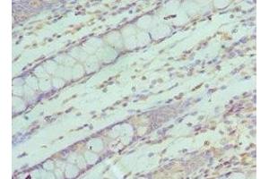 Immunohistochemistry of paraffin-embedded human colon cancer using ABIN7170622 at dilution of 1:100 (SF3B2 Antikörper  (AA 616-895))