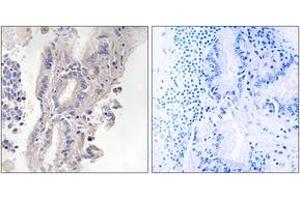Immunohistochemistry analysis of paraffin-embedded human lung carcinoma, using PLCXD1 Antibody. (PLCXD1 Antikörper  (AA 187-236))