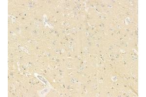 ABIN6259890 and ABIN6279111 at 1/100 staining human glioblastoma by IHC-P. (ALMS1 Antikörper  (C-Term))