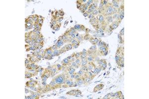 Immunohistochemistry of paraffin-embedded human liver cancer using SYT4 antibody (ABIN6129135, ABIN6148791, ABIN6148792 and ABIN6223676) at dilution of 1:100 (40x lens).