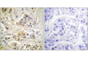 Immunohistochemistry analysis of paraffin-embedded human breast carcinoma tissue, using AhR (Ab-36) Antibody. (Aryl Hydrocarbon Receptor Antikörper  (AA 2-51))