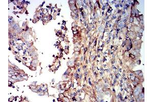 Immunohistochemical analysis of paraffin-embedded endometrial cancer tissues using IGHM mouse mAb with DAB staining. (IGHM Antikörper  (AA 310-452))