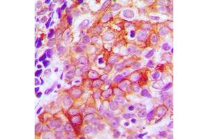 Immunohistochemical analysis of Beta-2 Adrenergic Receptor staining in human prostate cancer formalin fixed paraffin embedded tissue section. (beta 2 Adrenergic Receptor Antikörper  (C-Term))