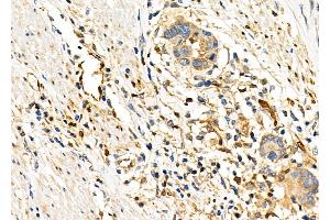 ABIN6263511 and ABIN6276331 at 1/100 staining Human esophageal cancer by IHC-P. (NAMPT Antikörper  (C-Term))