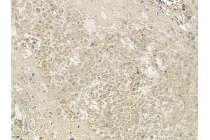 ABIN6259541 and ABIN6273711 at 1/100 staining human prostate carcinoma by IHC-P. (REV1 Antikörper  (C-Term))