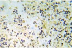 Immunohistochemistry (IHC) analyzes of p-ER-a (pSer118) pAb in paraffin-embedded human breast carcinoma tissue. (Estrogen Receptor alpha Antikörper  (pSer118))