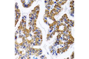 Immunohistochemistry of paraffin-embedded human gastric cancer using FASN antibody. (Fatty Acid Synthase Antikörper)