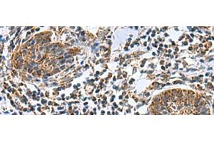 Immunohistochemistry of paraffin-embedded Human esophagus cancer tissue using MRPL40 Polyclonal Antibody at dilution of 1:80(x200) (MRPL40 Antikörper)
