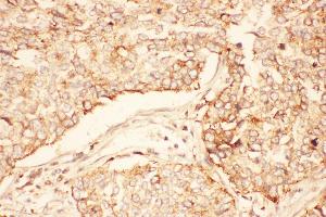 Anti-AKT2 Picoband antibody,  IHC(P): Human Lung Cancer Tissue (AKT2 Antikörper  (C-Term))