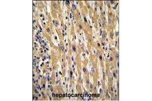 GAL Antibody (Center) (ABIN655055 and ABIN2844684) immunohistochemistry analysis in formalin fixed and paraffin embedded human hepatocarcinoma followed by peroxidase conjugation of the secondary antibody and DAB staining. (GAL Antikörper  (AA 48-79))