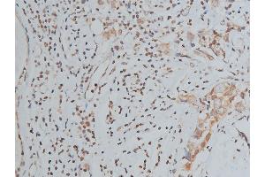 ABIN6267039 at 1/200 staining human breast cancer tissue sections by IHC-P. (Histone 3 Antikörper)