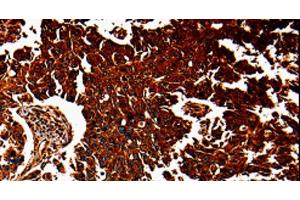 Immunohistochemistry of paraffin-embedded Human lung cancer tissue using ANXA7 Polyclonal Antibody at dilution 1:40 (Annexin VII Antikörper)