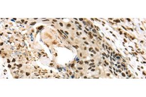 Immunohistochemistry of paraffin-embedded Human esophagus cancer using TALDO1 Polyclonal Antibody at dilution of 1/30