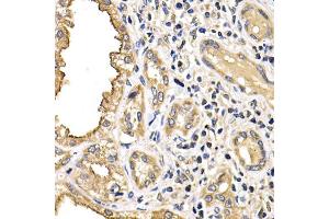 Immunohistochemistry of paraffin-embedded human kidney cancer using ARRB2 antibody (ABIN6290073) at dilution of 1:200 (40x lens).