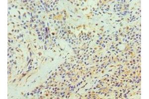 Immunohistochemistry of paraffin-embedded human breast cancer using ABIN7172210 at dilution of 1:100 (TFPI2 Antikörper  (AA 23-235))