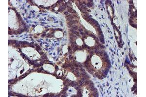 Immunohistochemical staining of paraffin-embedded Adenocarcinoma of Human colon tissue using anti-SMS mouse monoclonal antibody. (SMS Antikörper)