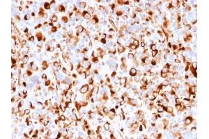 Formalin-fixed, paraffin-embedded human Melanoma stained with NGFR Mouse Recombinant Monoclonal Antibody (rNGFR/1965). (Rekombinanter NGFR Antikörper  (AA 281-421))