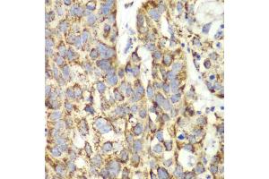 Immunohistochemistry of paraffin-embedded human lung cancer using UGDH antibody (ABIN6293152) at dilution of 1:100 (40x lens). (UGDH Antikörper)