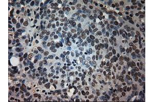 Immunohistochemical staining of paraffin-embedded Adenocarcinoma of colon tissue using anti-PROM2mouse monoclonal antibody. (Prominin 2 Antikörper)