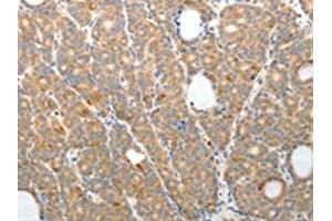 The image on the left is immunohistochemistry of paraffin-embedded Human thyroid cancer tissue using (TEP1 Antibody) at dilution 1/50, on the right is treated with synthetic peptide. (TEP1 Antikörper)