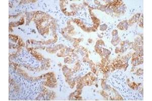 IHC staining of human lung cancer tissue, diluted at 1:200. (Cytokeratin 7 Antikörper)