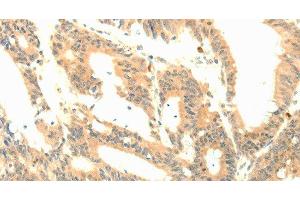 Immunohistochemistry of paraffin-embedded Human colon cancer tissue using P23 Polyclonal Antibody at dilution 1:50 (CDK5R1 Antikörper)