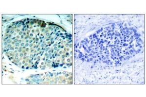 Immunohistochemical analysis of paraffin-embedded human breast carcinoma tissue, using HSP27 (phospho- Ser78) antibody (E011247). (HSP27 Antikörper  (pSer78))