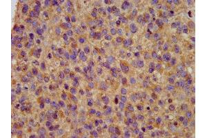 IHC image of ABIN7163983 diluted at 1:200 and staining in paraffin-embedded human glioma performed on a Leica BondTM system. (Kcne3 Antikörper  (AA 1-57))