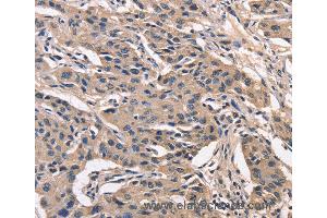 Immunohistochemistry of Human lung cancer using PEBP1 Polyclonal Antibody at dilution of 1:40 (PEBP1 Antikörper)