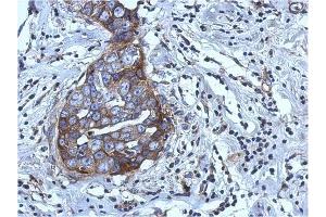 AP31123PU-N RGS4 antibody staining of Paraffin-Embedded Breast Carcinoma at 1/500 dilution. (RGS4 Antikörper  (AA 1-188))
