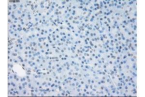 Immunohistochemical staining of paraffin-embedded Adenocarcinoma of ovary tissue using anti-SORDmouse monoclonal antibody.