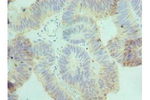 Immunohistochemistry of paraffin-embedded human colon cancer using ABIN7149071 at dilution of 1:100 (AXUD1 Antikörper  (AA 1-200))