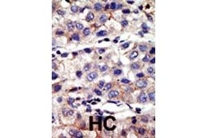 Formalin-fixed and paraffin-embedded human hepatocellular carcinoma tissue reacted with CBX4 polyclonal antibody  , which was peroxidase-conjugated to the secondary antibody, followed by AEC staining. (CBX4 Antikörper  (N-Term))