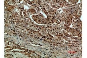 Immunohistochemical analysis of paraffin-embedded human-breast-cancer, antibody was diluted at 1:200 (DCT Antikörper  (AA 1268-1341))